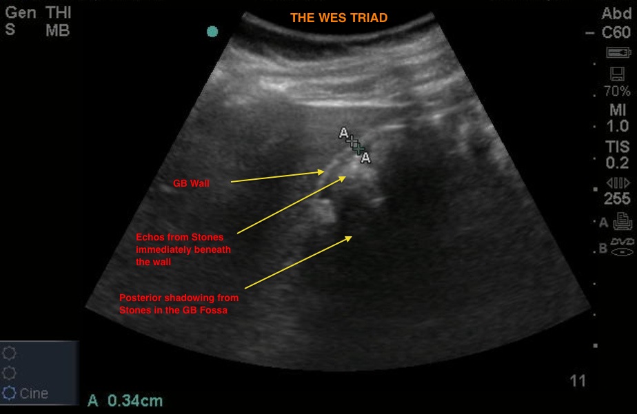 Chronic Cholecystitis Ultrasound Wes Sign