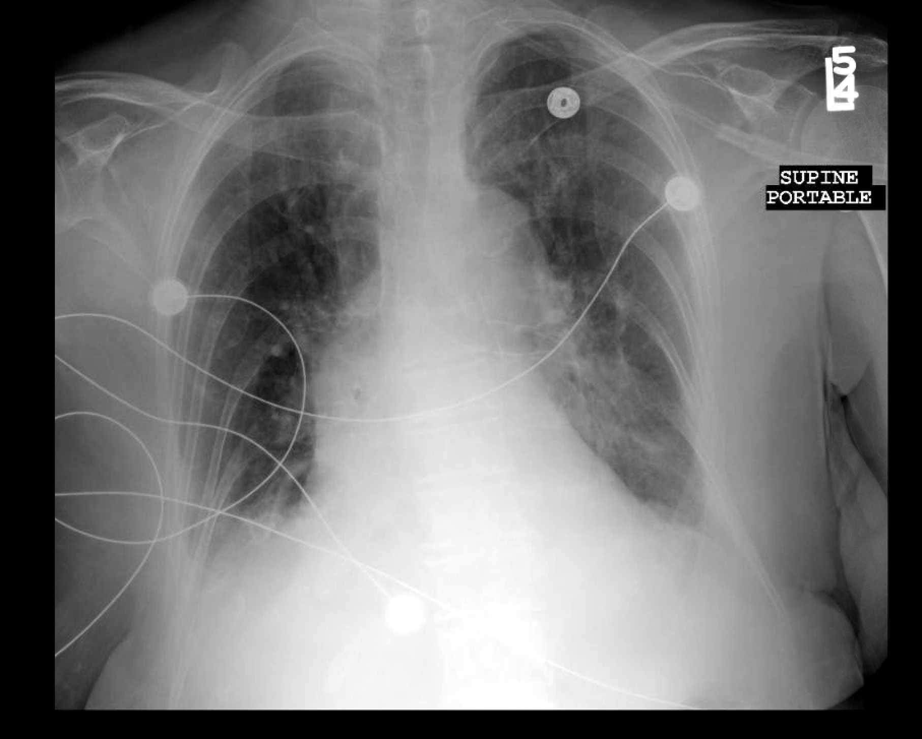 XR Sternal fracture