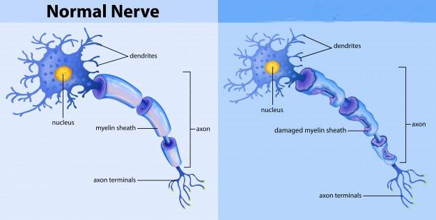Krabbe Disease | Emory School of Medicine