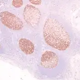 Teasing apart tonsillitis