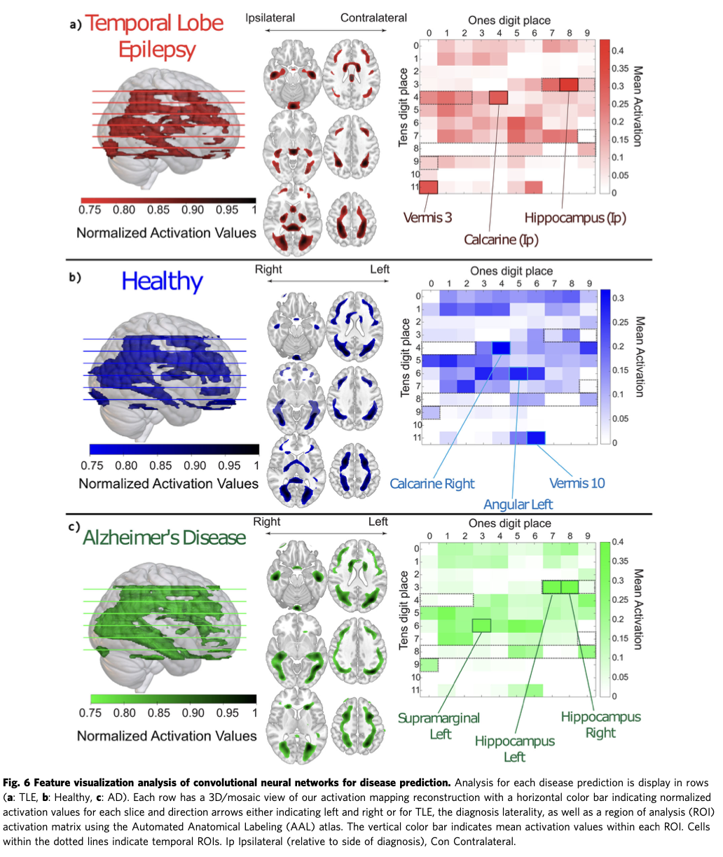 Brain regions whose MRI features are leveraged for disease classification