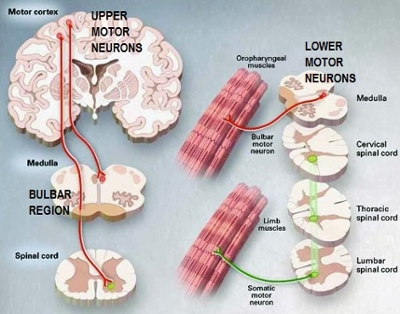 Lou Gehrig's Disease - Amyotrophic Lateral Sclerosis