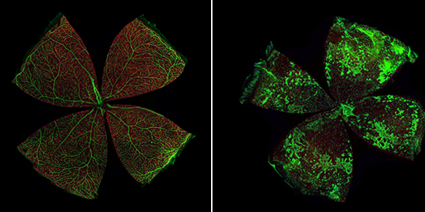 Retinal vasculature (green) and dopamine neurons (red) with normal development (left) and in an experimental model of ROP (right). Significant capillary dropout in the retinal center and presence of neovascular tufts in the periphery as well as DAC deficiency are observed in the ROP retina (right) while the control retina exhibits normal vascularization and an abundance of dopamine neurons throughout (left). 