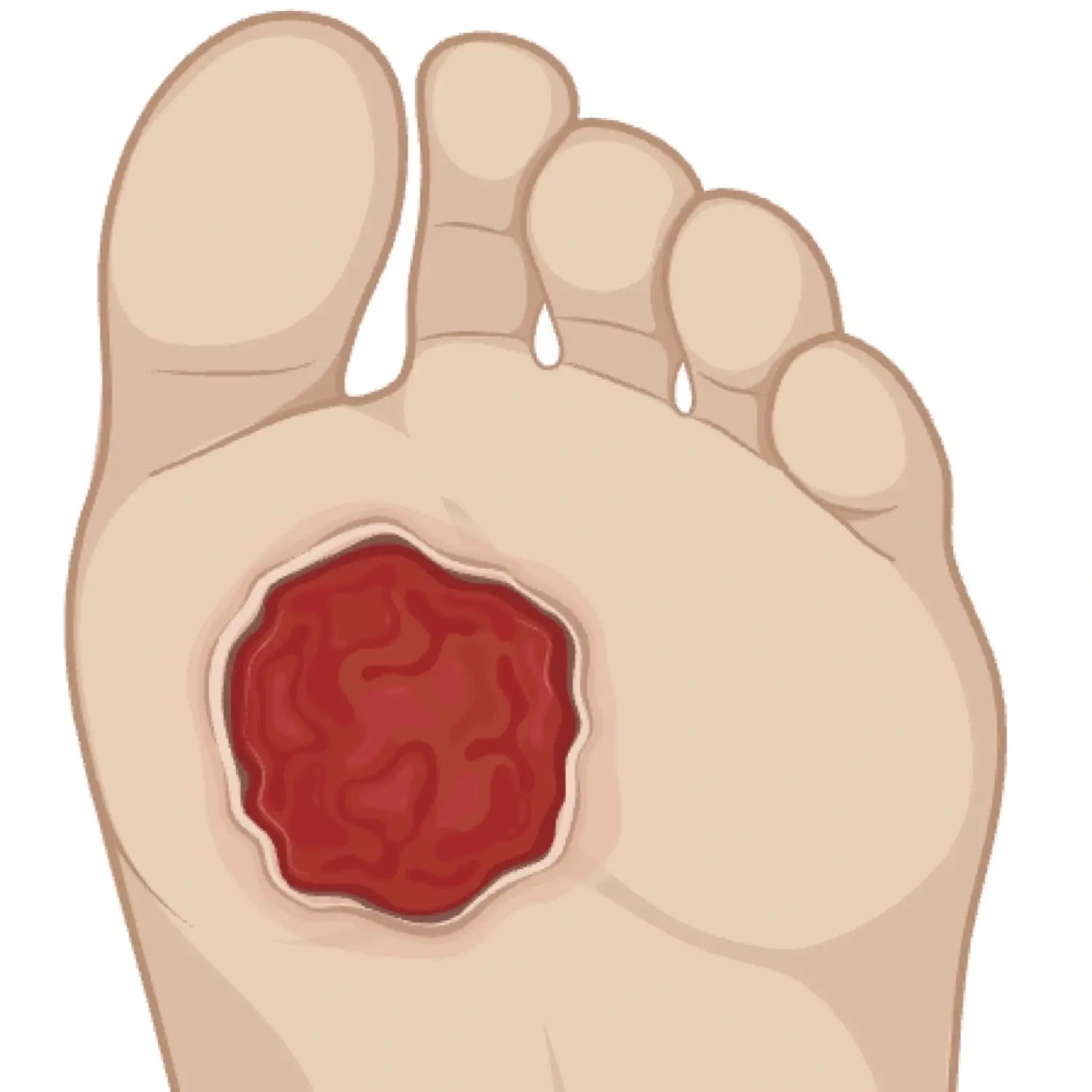 Diabetic Foot Ulcers