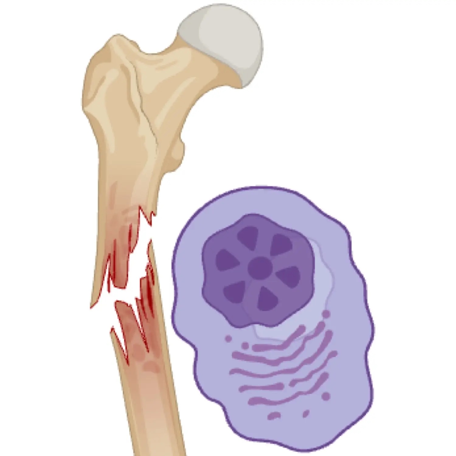 Multiple Myeloma