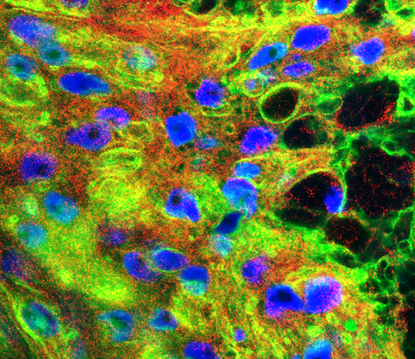 Confocal mirograph tumor cells