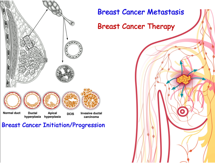 Breast Cancer Mestastasis