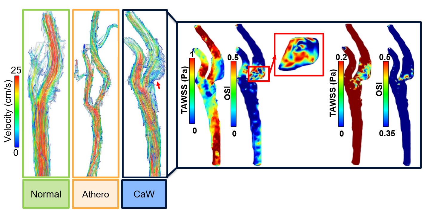 colorful images of blood flow velocity and other factors taken by 4D flow MRI