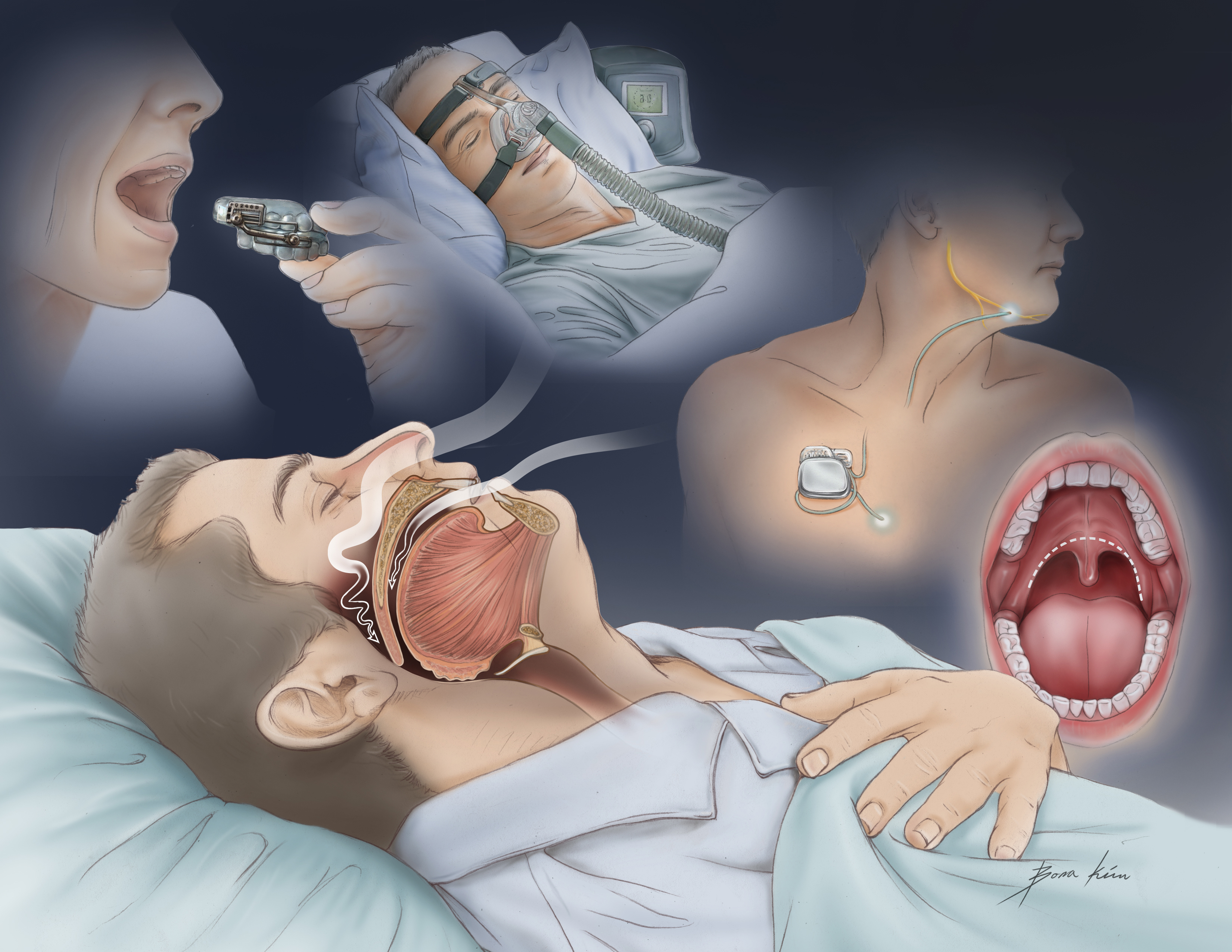 celran scool xxx sex dating with sleep apnea