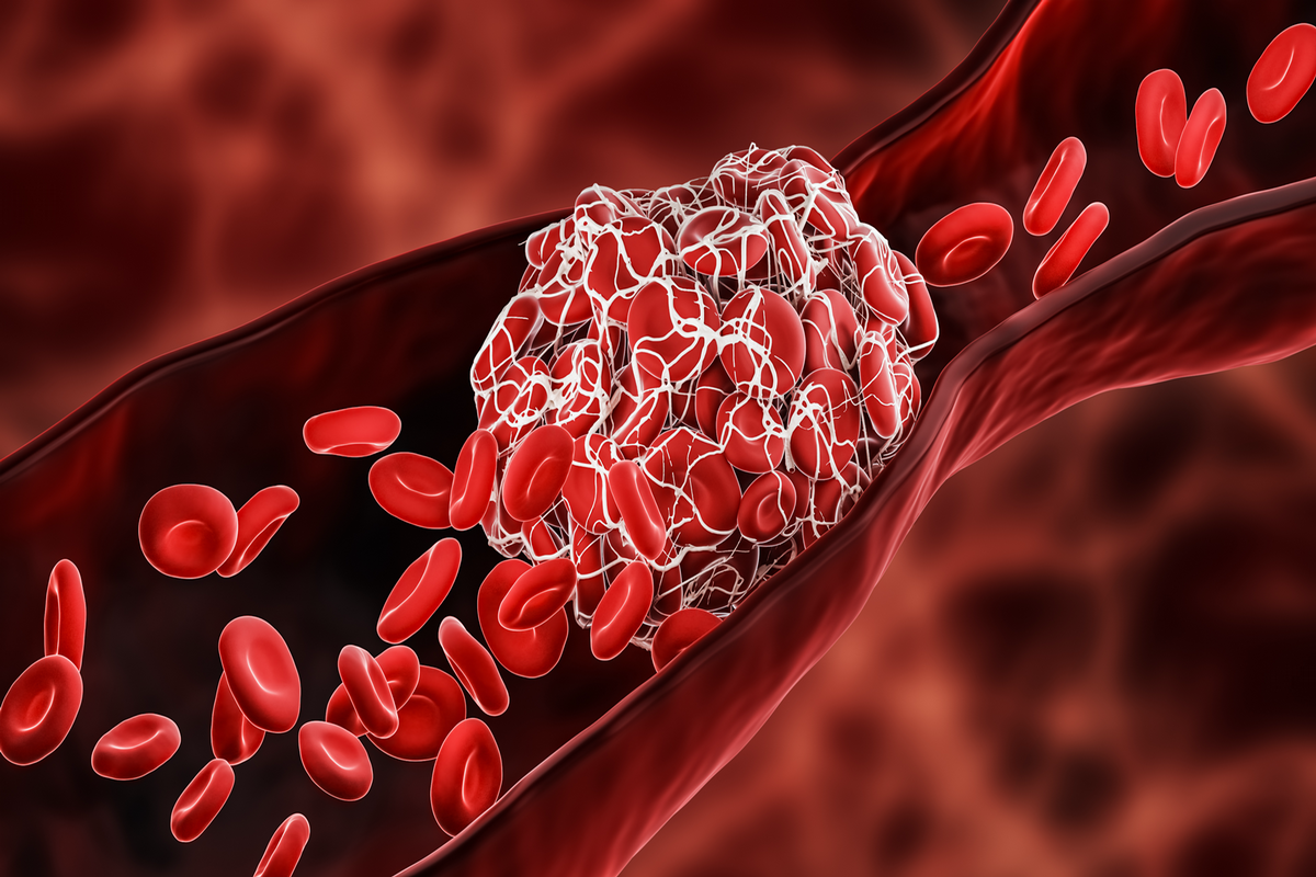 New research may revolutionize how stroke, heart attack, related blood-clotting conditions are treated