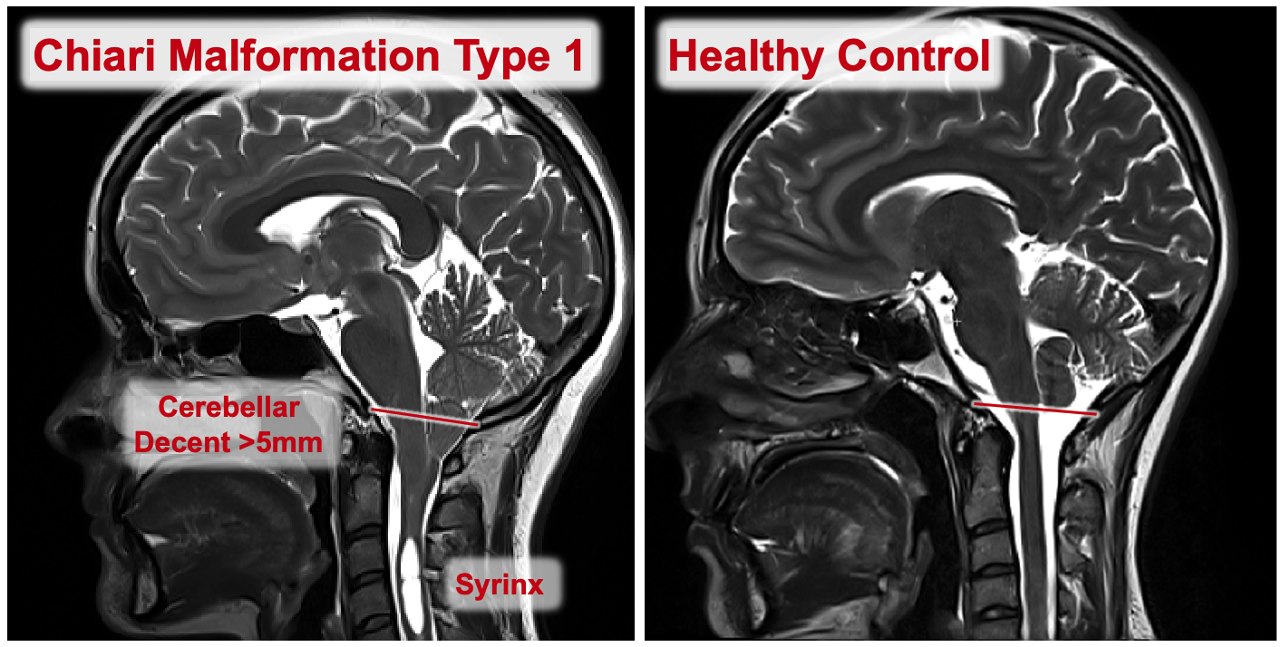 An image showing the difference between two people, one of who has symptoms of Chiari malformations
