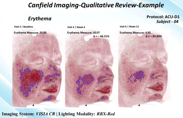 Representative Canfield imaging of patient in study. Patient is visualized at baseline, week 4, and week 12 of treatment with ACU-D1, allowing evaluation of erythema. Red pigmentation represents hemoglobin, while purple pigmentation represents melani