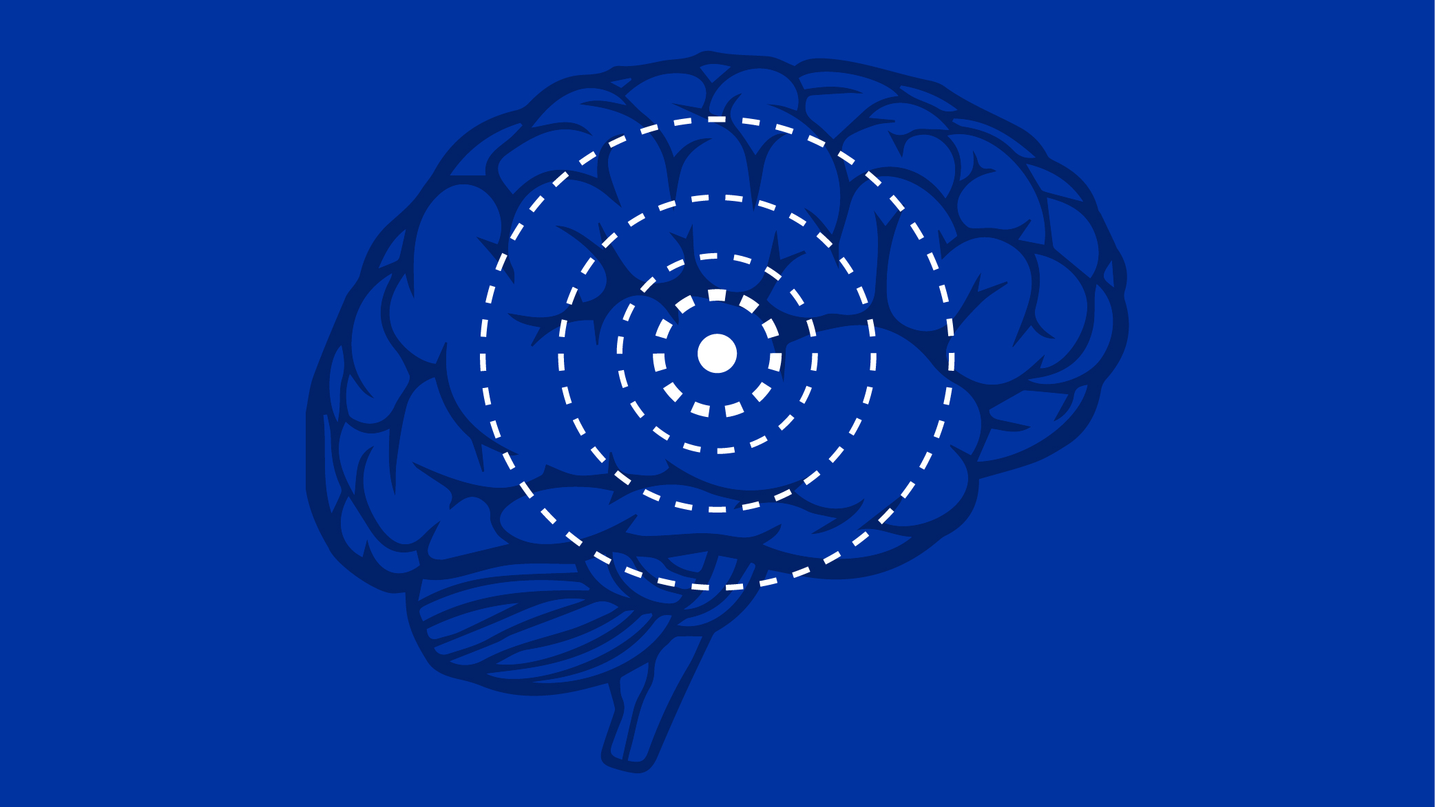 Diagram of deep brain stimulation
