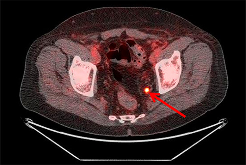 Pelvic uptake on fluciclovine imaging scan.